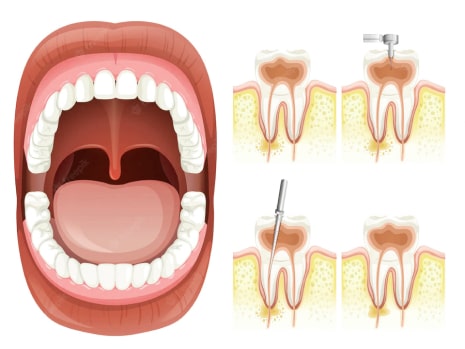 Root Canal 3