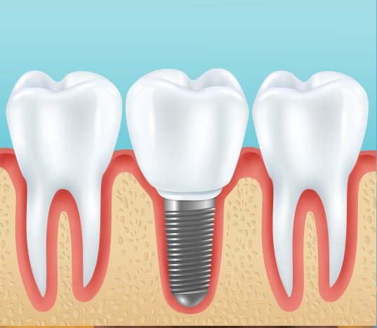 Dental Implants Image 