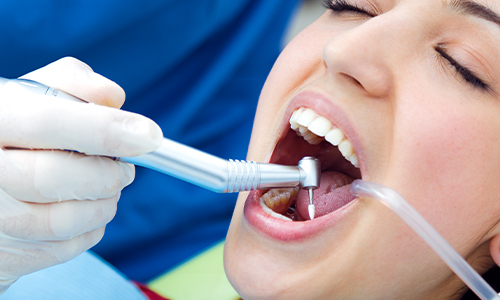 What are the Benefits of Root Canal