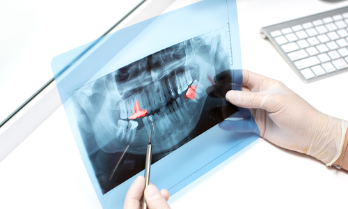 Signs You Need Your Wisdom Teeth Removed